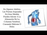 Piernas Chuecas Solucion, Ejercicios Para Las Piernas Arqueadas, Piernas Arqueadas Tratamiento